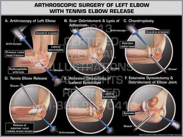 Arthroscopic Surgery of Left Elbow with Tennis Elbow Release