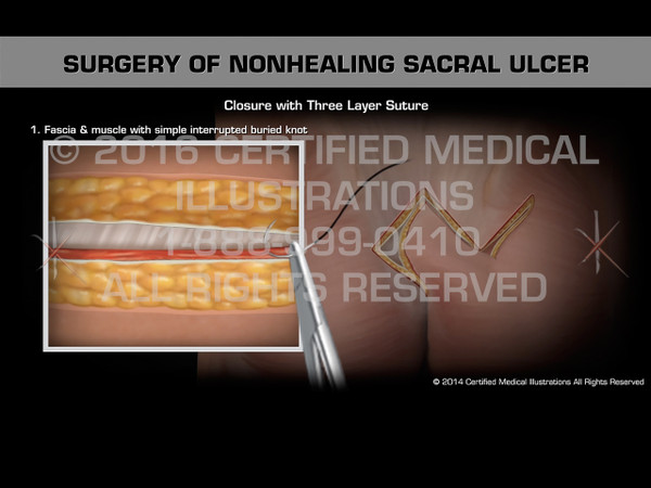 Animation of Surgery of Nonhealing Sacral Ulcer - Medical Animation