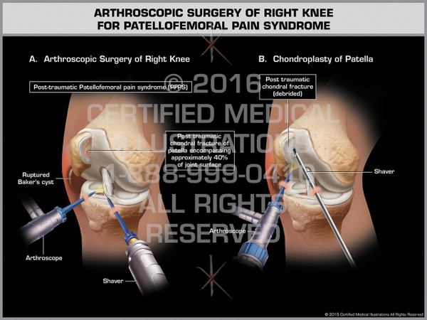 Exhibit of Arthroscopic Surgery of Right Knee for Patellofemoral Pain Syndrome - Print Quality Instant Download