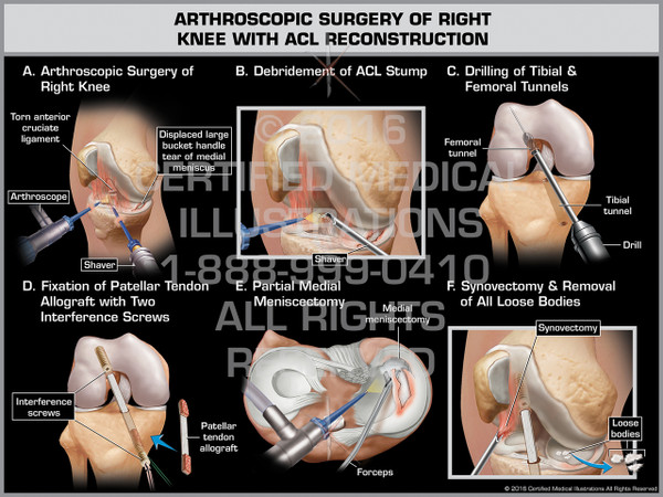 Exhibit of Arthroscopic Surgery of Right Knee with ACL Reconstruction - Print Quality Instant Download