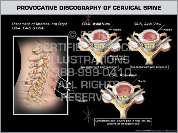 Exhibit of Provocative Discography of Cervical Spine