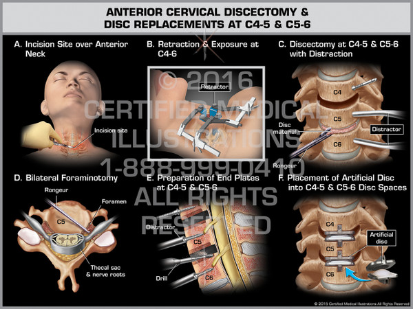 Exhibit of Anterior Cervical Discectomy & Replacement at C4-5 & C5-6 - Print Quality Instant Download