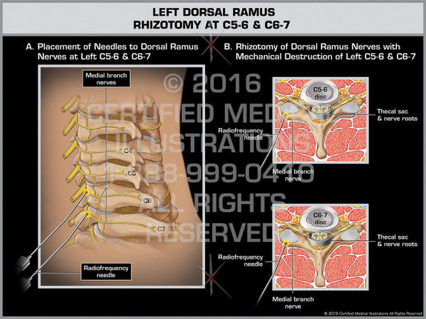 Exhibit of Left Dorsal Ramus Rhizotomy at C5-6 & C6-7 - Print Quality Instant Download