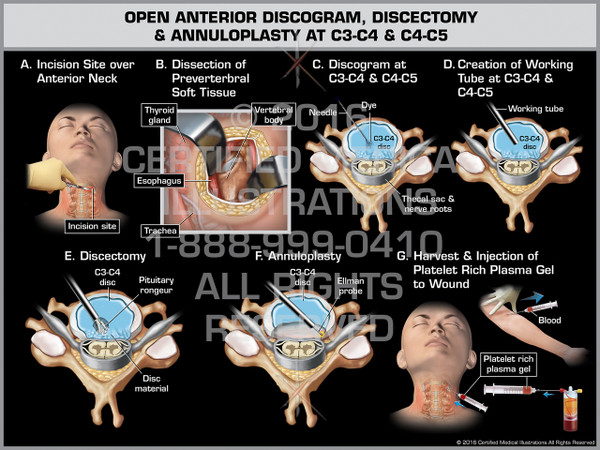 Exhibit of Open Anterior Discogram, Discectomy & Annuloplasty at C3-C4 & C4-C5