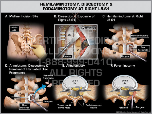 Exhibit of Hemilaminotomy, Discectomy & Foraminotomy at Right L5-S1 