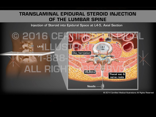 Animation of Translaminal Epidural Steroid Injection of the Lumbar Spine - Medical Animation (Female)