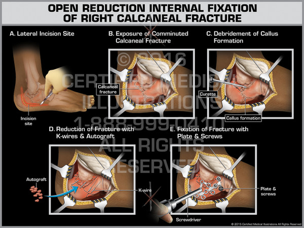 Exhibit of Open Reduction Internal Fixation of Right Calcaneal Fracture - Print Quality Instant Download