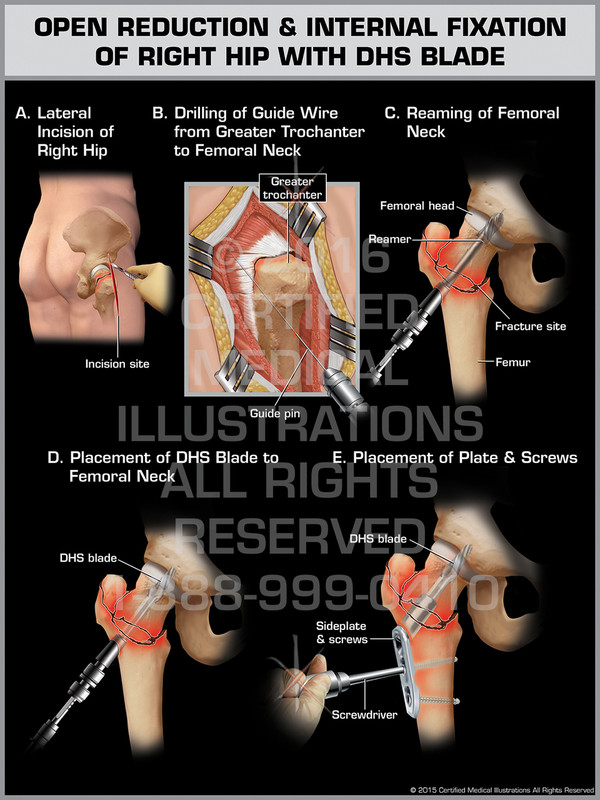 Exhibit of Open Reduction & Internal Fixation of Right Hip with DHS Blade - Print Quality Instant Download
