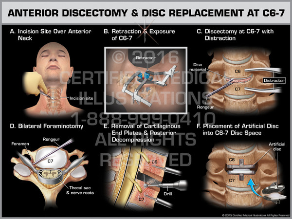 Exhibit of Anterior Discectomy & Disc Replacement at C6-7 - Print Quality Instant Download