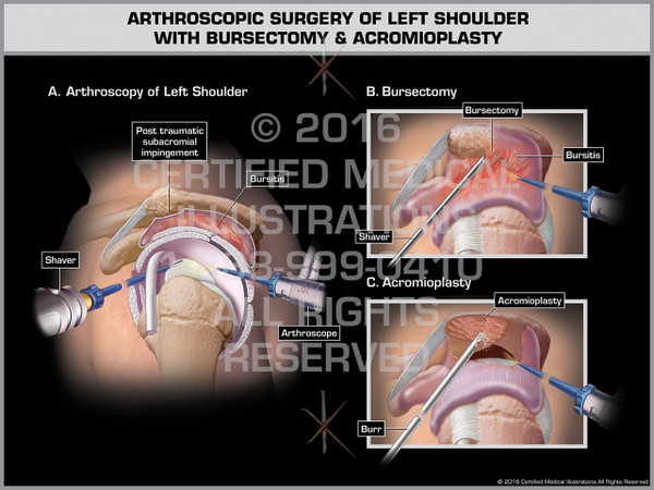 Exhibit of Arthroscopic Surgery of Left Shoulder with Bursectomy & Acromioplasty - Print Quality Instant Download