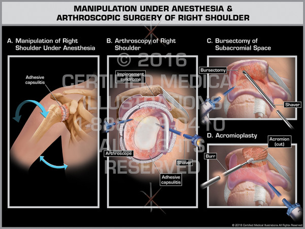 Exhibit of Manipulation Under Anesthesia & Arthroscopic Surgery of Right Shoulder - Print Quality Instant Download