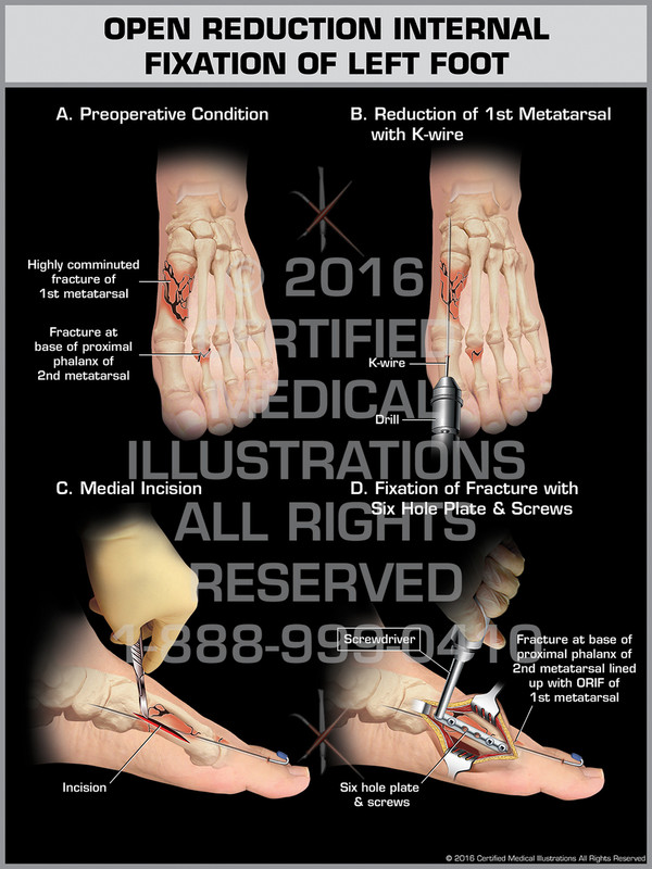 Exhibit of Open Reduction Internal Fixation of Left Foot