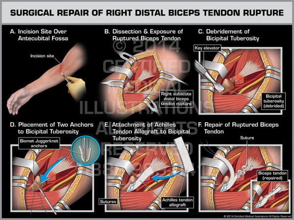 Surgical Repair of Right Distal Biceps Tendon Rupture