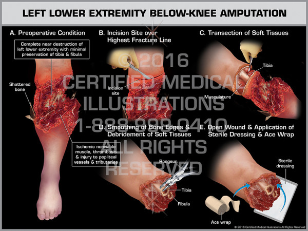 Exhibit of Left Lower Extremity Below-Knee Amputation