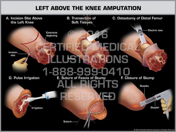Exhibit of Left Above the Knee Amputation - Print Quality Instant Download
