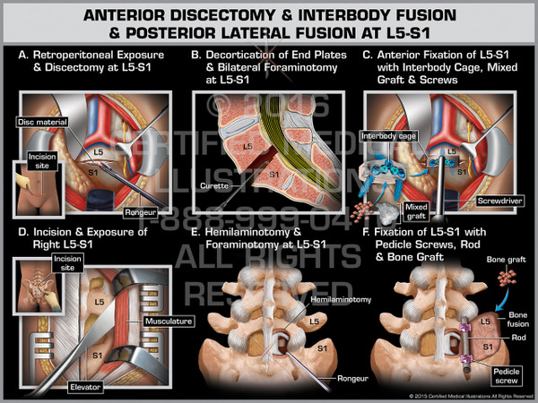 Exhibit of Anterior Discectomy & Interbody Fusion & Posterior Lateral Fusion at L5-S1