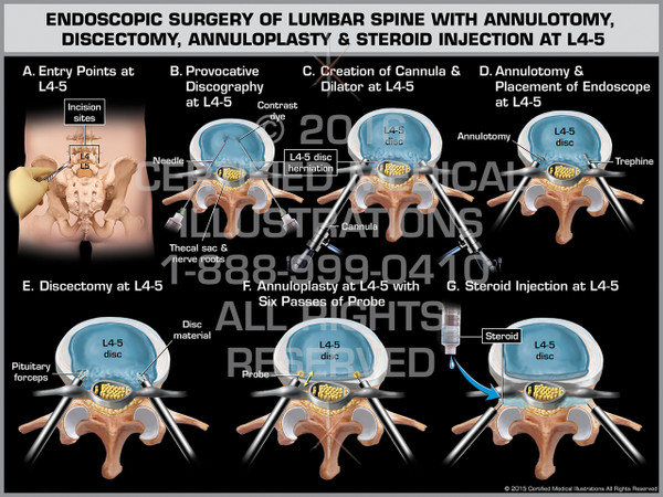 Exhibit of Endoscopic Surgery of Lumbar Spine with Annulotomy, Discectomy, Annuloplasty & Steroid Injection at L4-5
