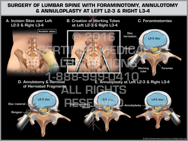 Exhibit of Surgery of Lumbar Spine with Foraminotomy, Annulotomy & Annuloplasty at Left L2-3 & Right L3-4