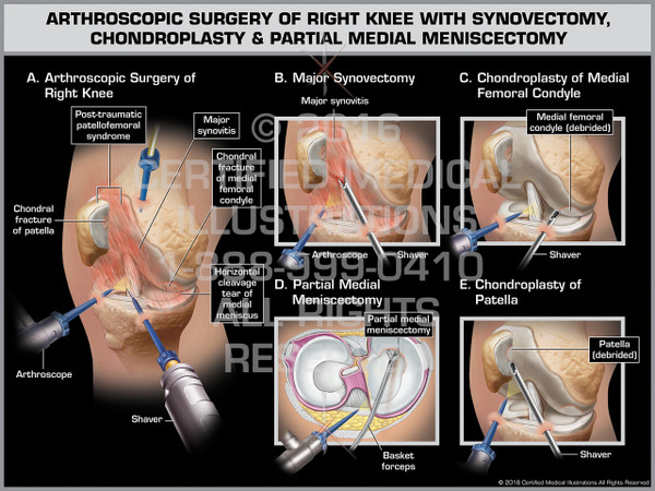 Exhibit of Arthroscopic Surgery of Right Knee with Synovectomy, Chondroplasty & Partial Medial Meniscectomy