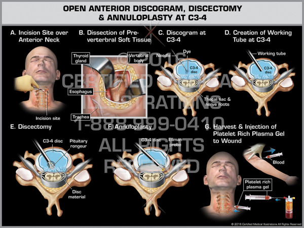 Exhibit of Open Anterior Discogram, Discectomy & Annuloplasty at C3-4