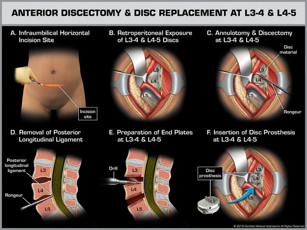 Exhibit of Anterior Discectomy & Disc Replacement at L3-4 & L4-5