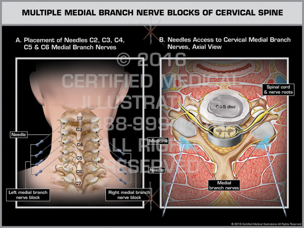 Exhibit of Multiple Medial Branch Nerve Blocks of Cervical Spine