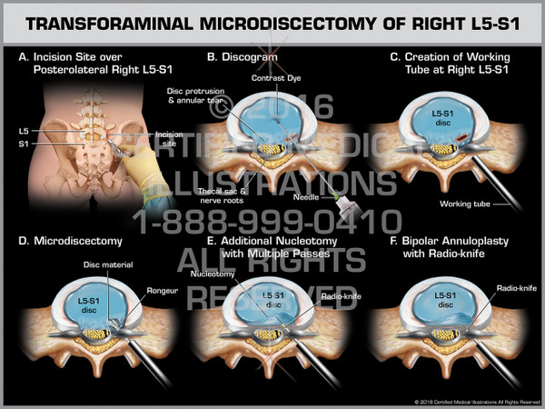 Exhibit of Transforaminal Microdiscectomy of Right L5-S1 - Print Quality Instant Download