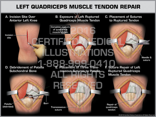 Exhibit of Left Quadriceps Muscle Tendon Repair