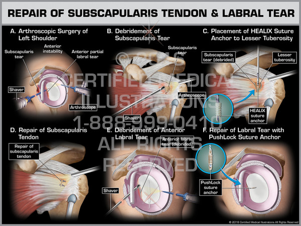 Exhibit of Repair of Subscapularis Tendon & Labral Tear - Print Quality Instant Download