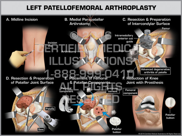 Exhibit of Left Patellofemoral Arthroplasty