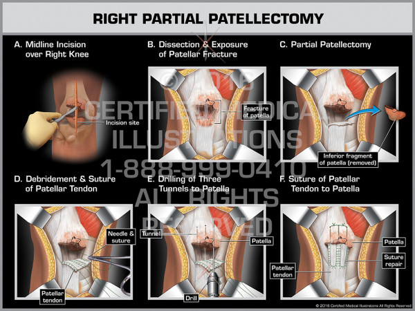 Exhibit of Right Partial Patellectomy - Print Quality Instant Download