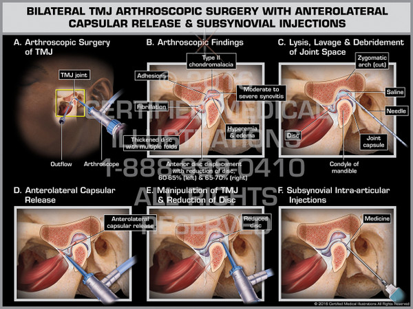 Exhibit of Bilateral TMJ Arthroscopic Surgery with Anterolateral Capsular Release & Subsynovial Injections - Print Quality Instant Download