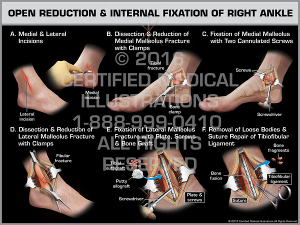 Exhibit of Open Reduction & Internal Fixation of Right Ankle