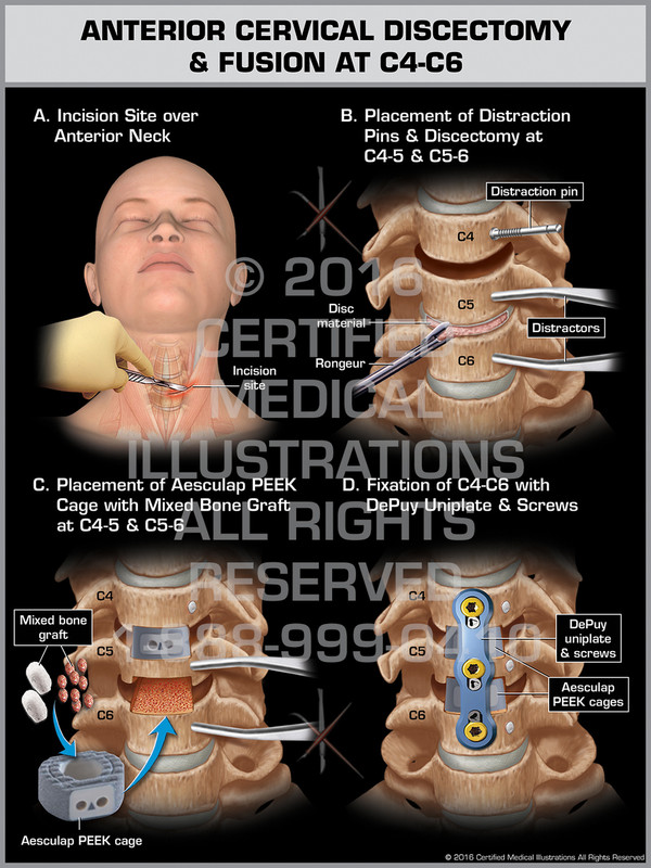 Exhibit of Anterior Cervical Discectomy & Fusion at C4-C6 - Print Quality Instant Download