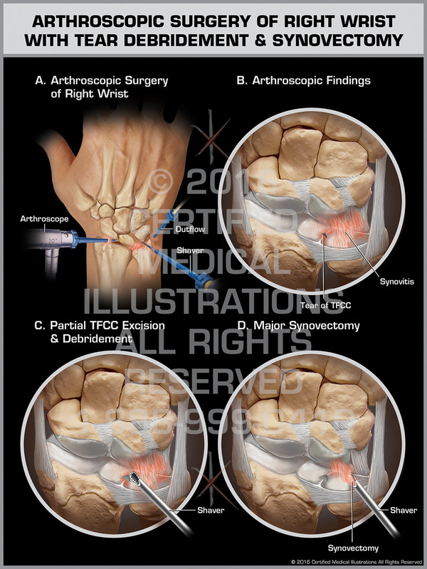 Exhibit of Arthroscopic Surgery of Right Wrist with Tear Debridement & Synovectomy