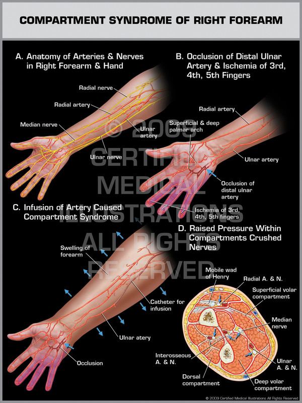 Compartment Syndrome of Right Forearm 1