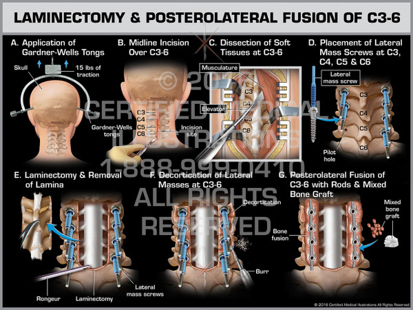 Exhibit of Laminectomy & Posterolateral Fusion of C3-6