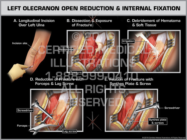 Exhibit of Left Olecranon Open Reduction & Internal Fixation - Print Quality Instant Download
