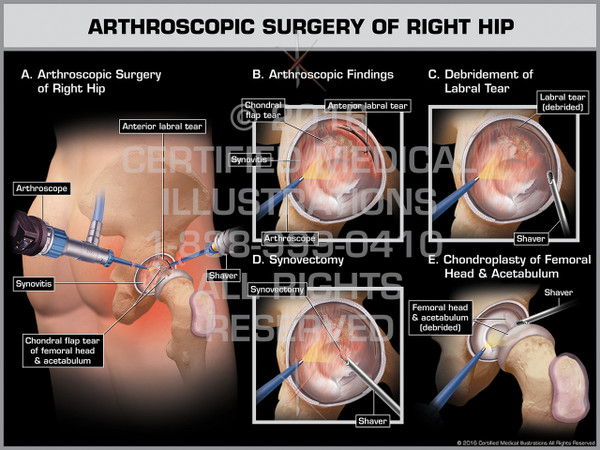 Exhibit of Arthroscopic Surgery of Right Hip - Print Quality Instant Download