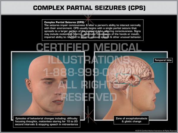 Exhibit of Complex Partial Seizures (CPS) - Print Quality Instant Download Exhibit of Complex Partial Seizures (CPS) - Print Quality Instant Download