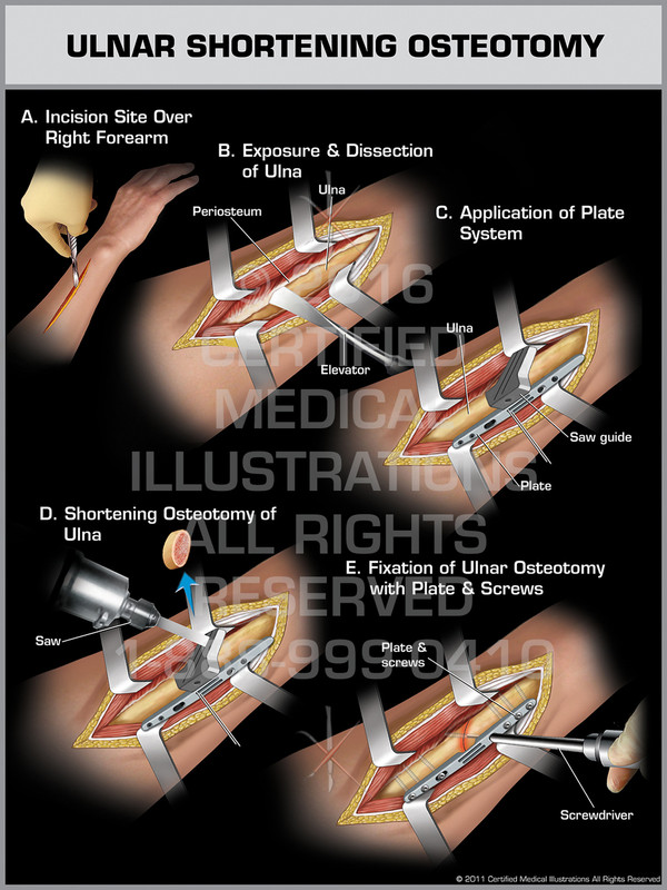 Ulnar Shortening Osteotomy