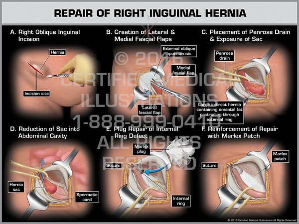 Exhibit of Repair of Right Inguinal Hernia - Print Quality Instant Download