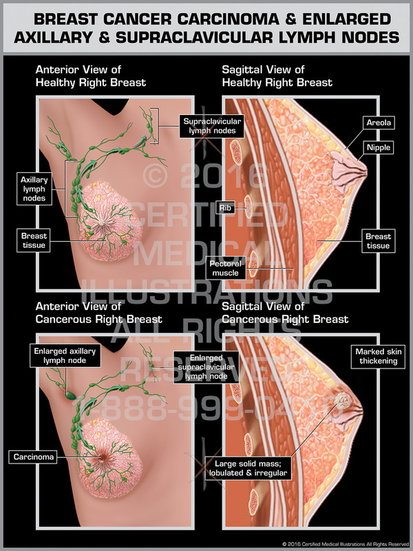 Exhibit of Breast Cancer Carcinoma & Englarged Axillary & Supraclavicular Lymph Nodes