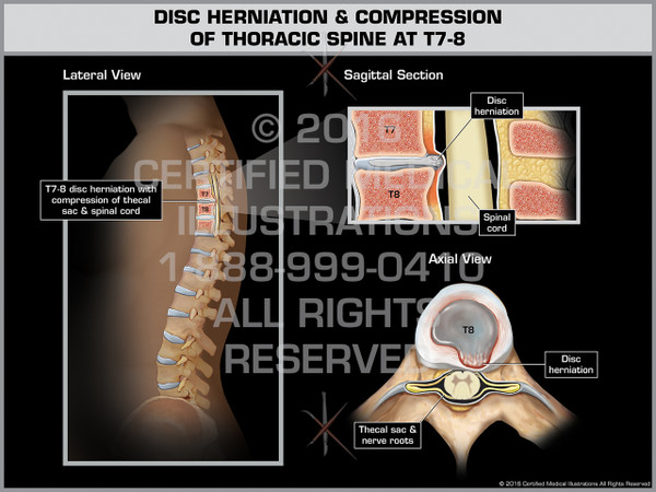 Exhibit of Disc Herniation & Compression of Thoracic Spine at T7-8