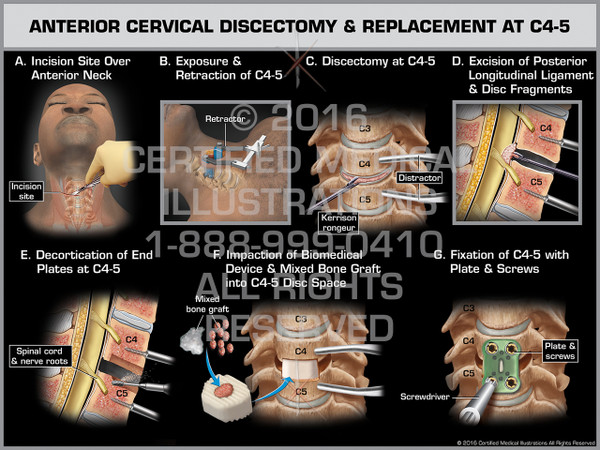 Exhibit of Anterior Cervical Discectomy & Replacement at C4-5 