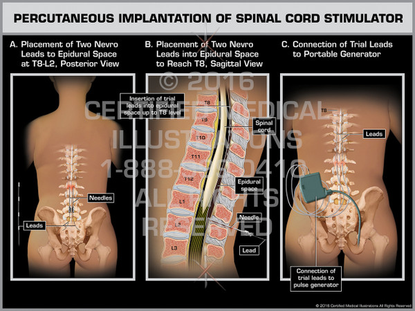 Exhibit of Percutaneous Implantation of Spinal Cord Stimulator - Print Quality Instant Download