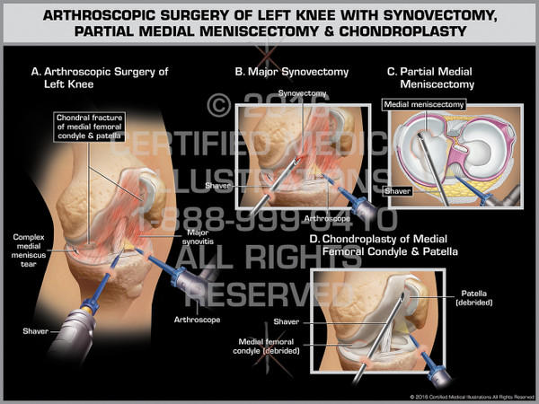 Exhibit of Arthroscopic Surgery of Left Knee with Synovectomy, Partial Medial Meniscectomy & Chondroplasty