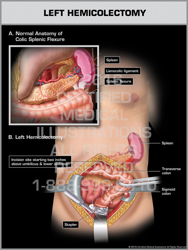 Exhibit of Left Hemicolectomy