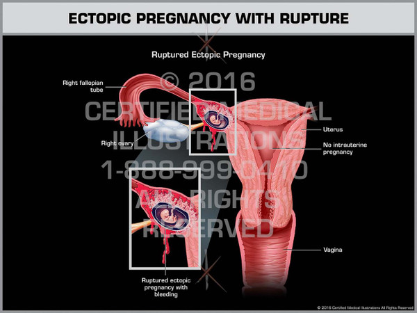 Exhibit of Ectopic Pregnancy with Rupture