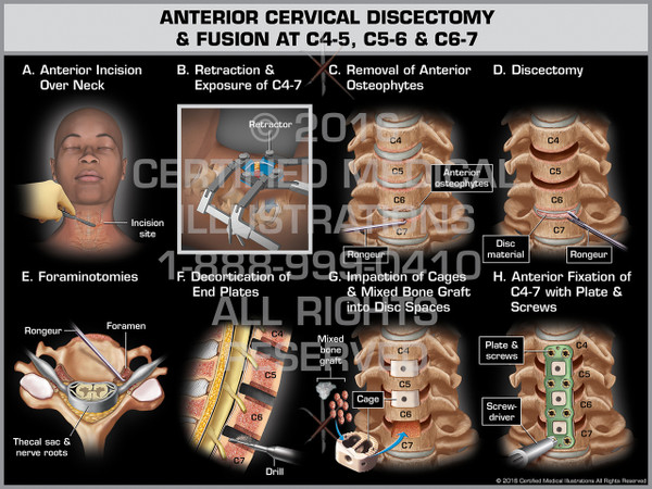 Exhibit of Anterior Cervical Discectomy & Fusion at C4-5, C5-6 & C6-7
